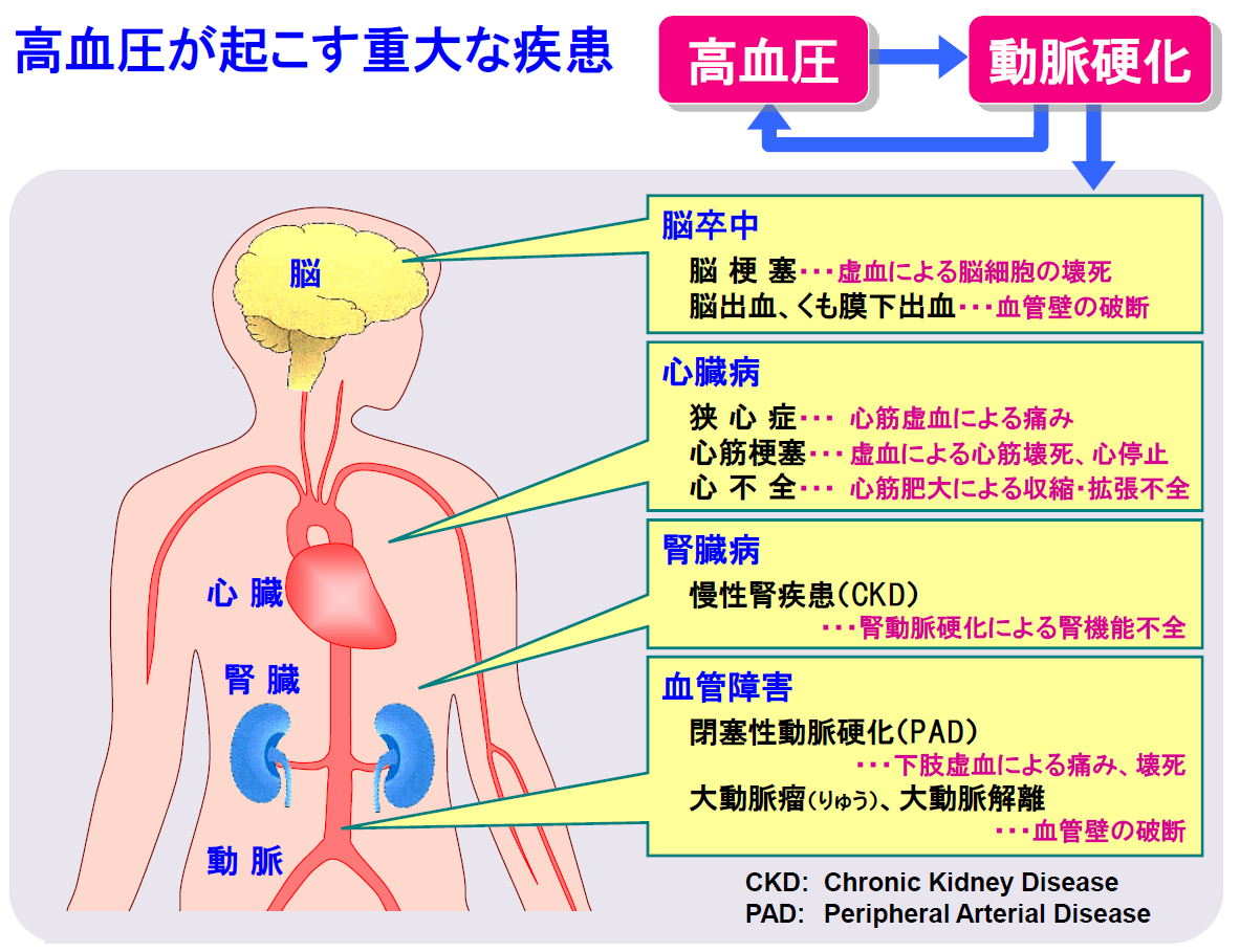 腎血管性高血圧症